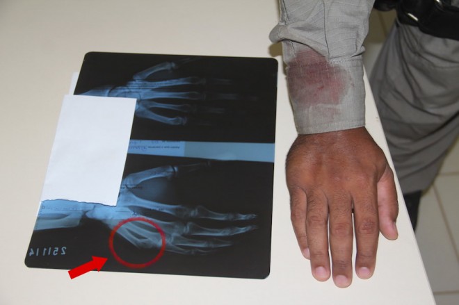 Raio-x mostra osso quebrado da mão do policial que tentava deter Gilson - Foto: Alexandre Lima