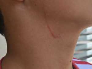 Jovem teve escoriações pelo rosto após briga em colégio (Foto: Adelcimar Carvalho/G1)