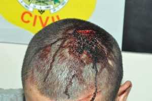 Um dos agressores foi ferido na cabeça durante a confusão/Foto: ContilNet