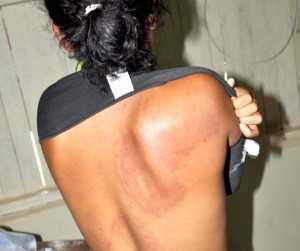 Mulher mostra marcas da agressão (Foto: Francisco Rocha/G1)