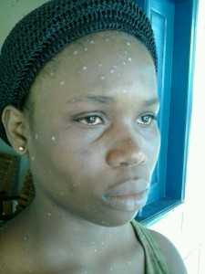 Mulher haitiana sofreu hematomas no rosto - Foto: oaltoacre.com