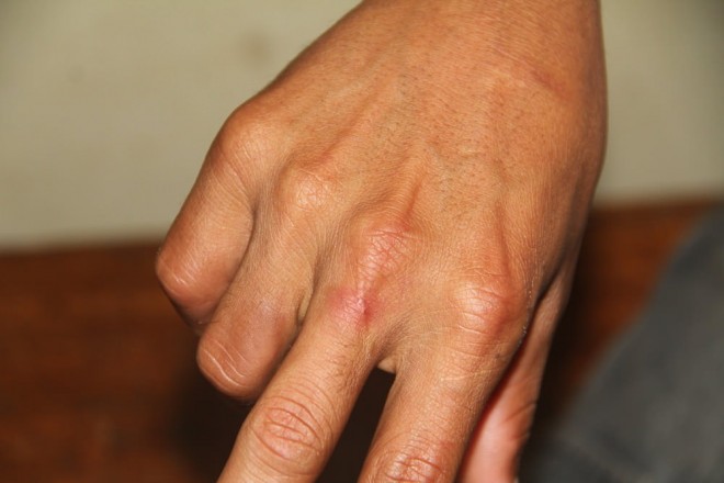 Edilson sofreu pequenos hematomas numa das mãos no momento do furto - Foto: Alexandre Lima