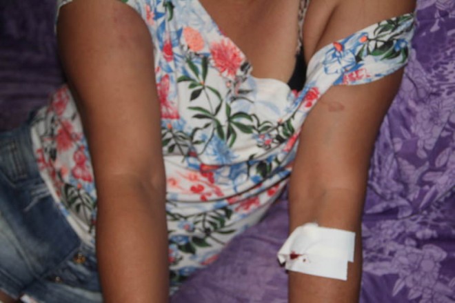 Vítima ficou com vários hematomas pelo corpo após sessão de espancamento - Foto: Alexandre Lima