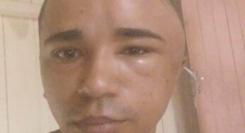 Jovem vítima de acidente luta para recomeçar a vida e pede apoio em Cruzeiro do Sul